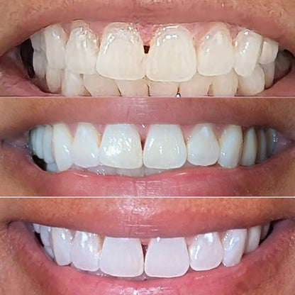 Smileasego Teeth Whitening Serum, Color-Correcting Serum to Neutralize Yellow Stains